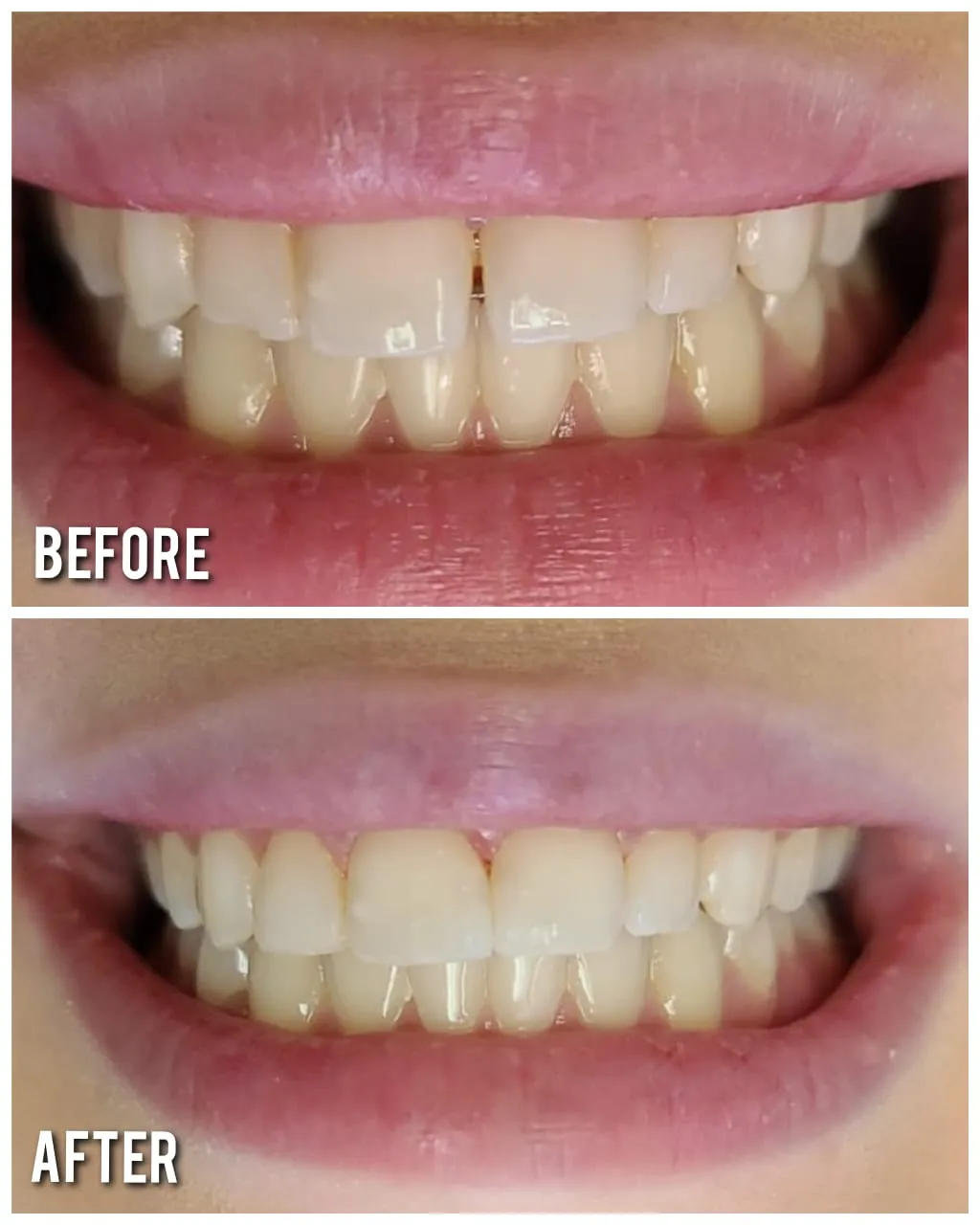 Patient teeth before professional whitening at Minty Smiles